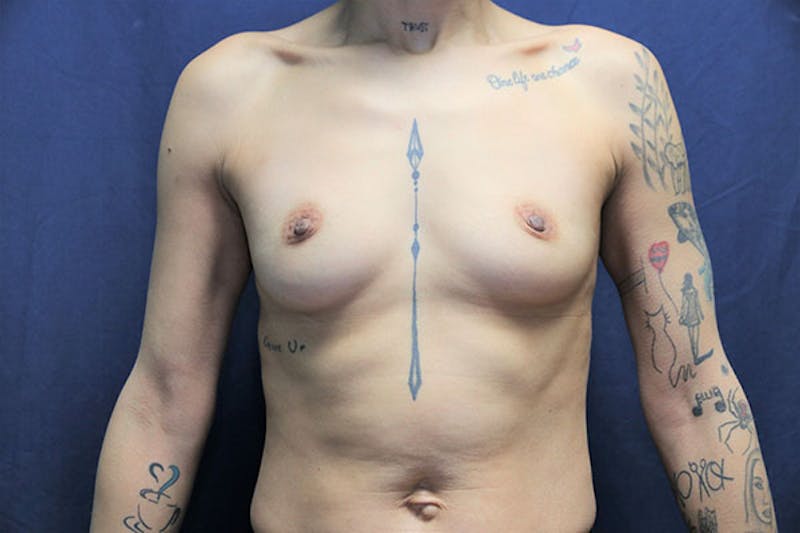 Augmentation (Enlargement) Before & After Gallery - Patient 156696 - Image 1