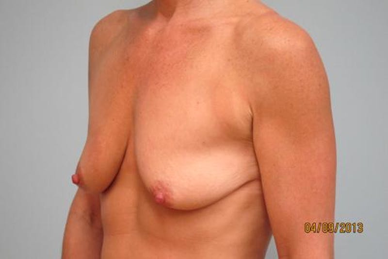 Mastopexy Augmentation Before & After Gallery - Patient 385085 - Image 5