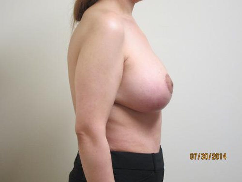 Mastopexy Augmentation Before & After Gallery - Patient 238085 - Image 4
