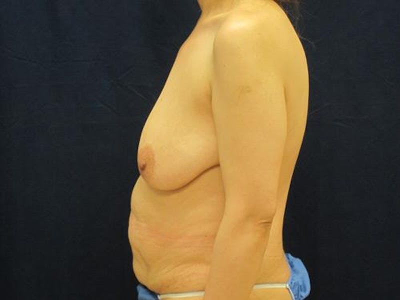 Mastopexy Augmentation Before & After Gallery - Patient 238085 - Image 7