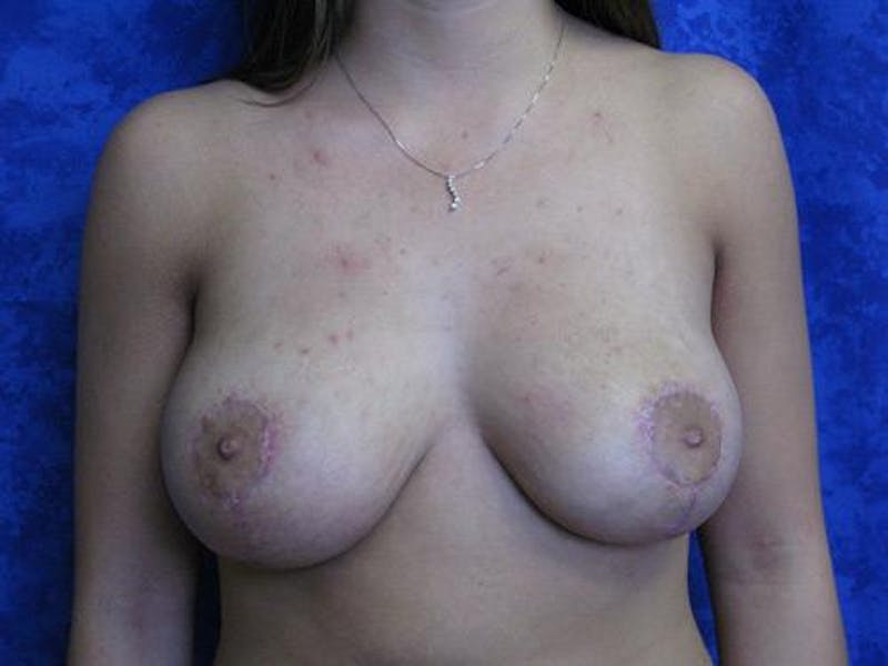 Mastopexy Before & After Gallery - Patient 483323 - Image 2