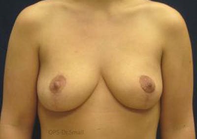 Mastopexy Before & After Gallery - Patient 169534 - Image 2