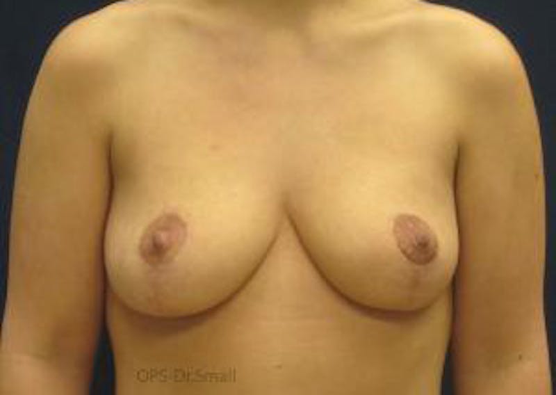 Mastopexy Before & After Gallery - Patient 169534 - Image 2