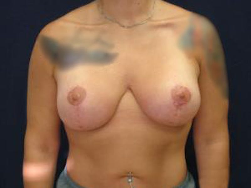 Mastopexy Before & After Gallery - Patient 375173 - Image 2