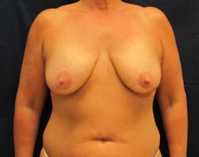 Mastopexy Before & After Gallery - Patient 303598 - Image 1