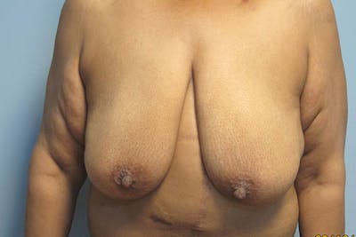 Mastopexy Before & After Gallery - Patient 236625 - Image 1