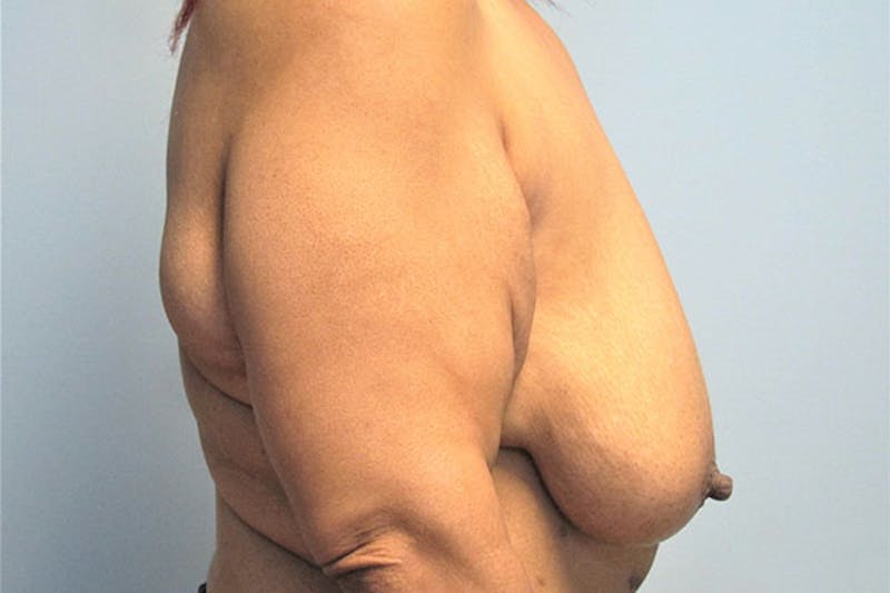Mastopexy Before & After Gallery - Patient 236625 - Image 3