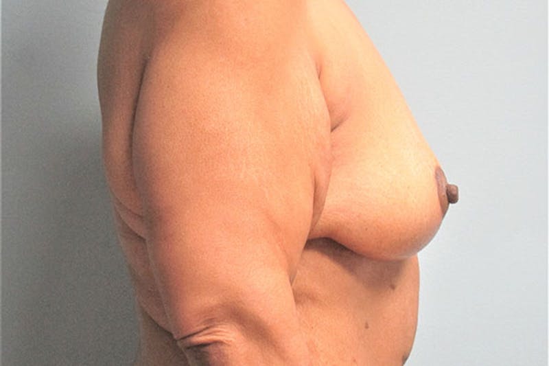Mastopexy Before & After Gallery - Patient 236625 - Image 4