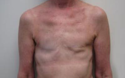 Reconstruction Before & After Gallery - Patient 239634 - Image 1