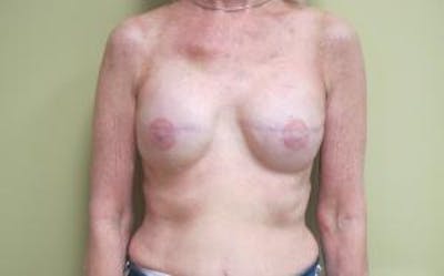 Reconstruction Before & After Gallery - Patient 239634 - Image 2
