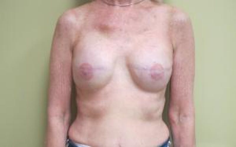 Reconstruction Before & After Gallery - Patient 239634 - Image 2