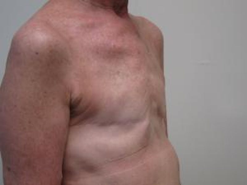 Reconstruction Before & After Gallery - Patient 239634 - Image 3