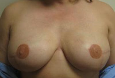 Reconstruction Before & After Gallery - Patient 565262 - Image 2