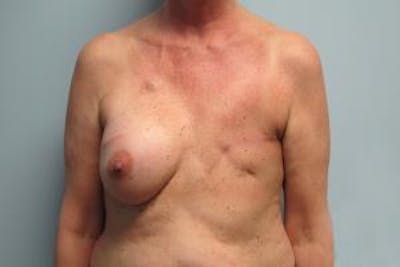 Reconstruction Before & After Gallery - Patient 240915 - Image 1