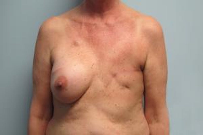 Reconstruction Before & After Gallery - Patient 240915 - Image 1