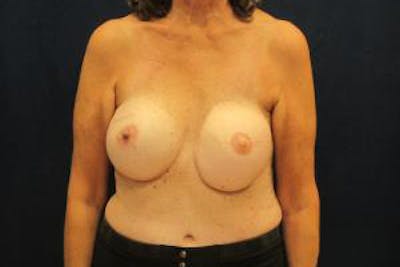Reconstruction Before & After Gallery - Patient 240915 - Image 2