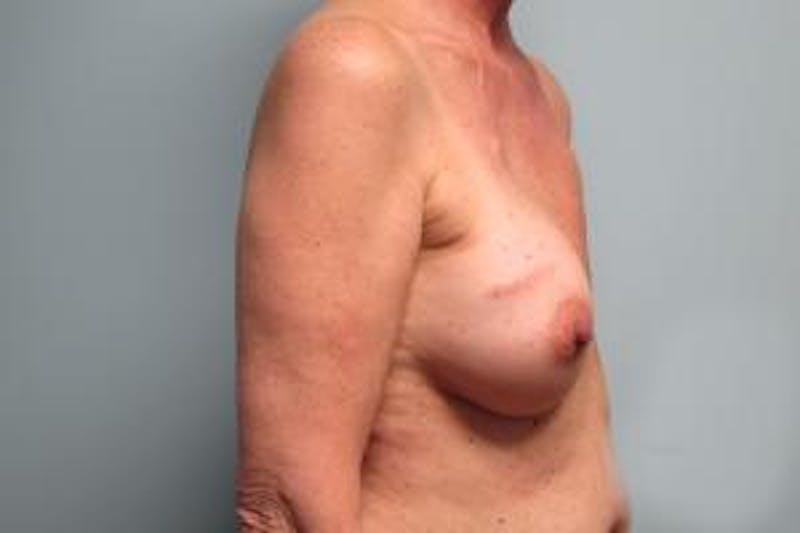 Reconstruction Before & After Gallery - Patient 240915 - Image 3
