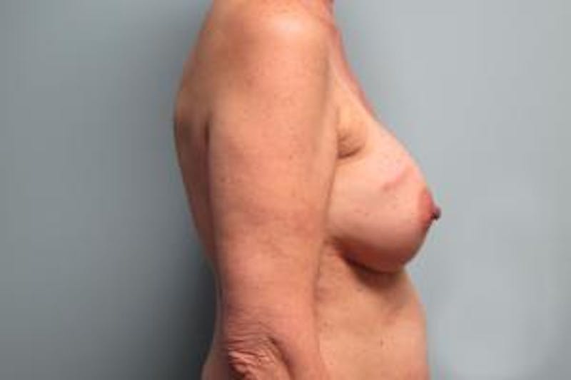 Reconstruction Before & After Gallery - Patient 240915 - Image 5
