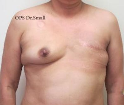 Reconstruction Before & After Gallery - Patient 209545 - Image 1