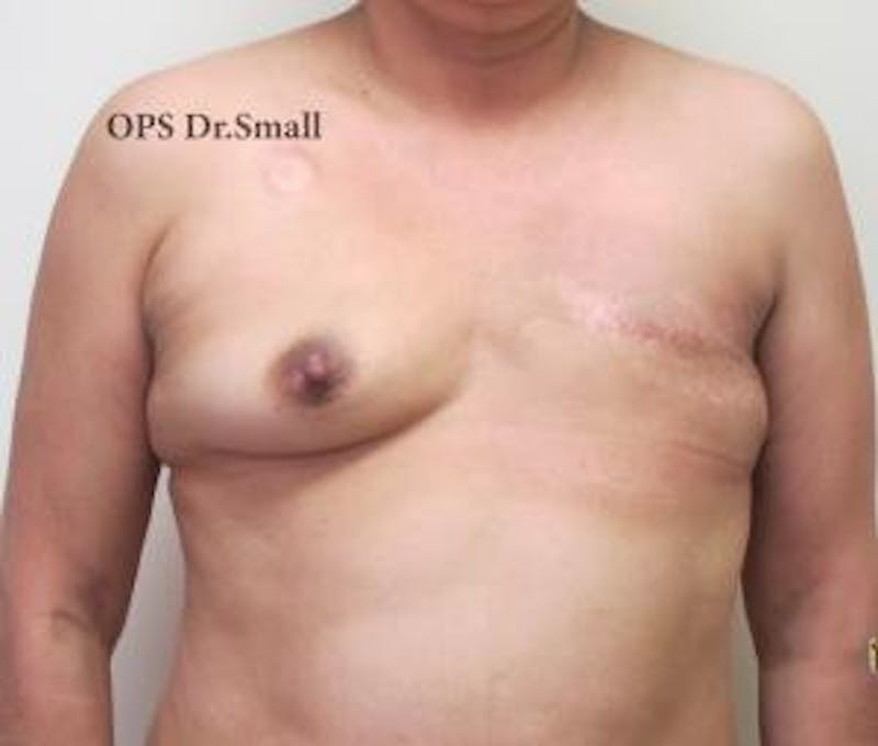 Reconstruction Before & After Gallery - Patient 209545 - Image 1