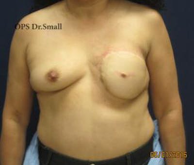 Reconstruction Before & After Gallery - Patient 209545 - Image 2