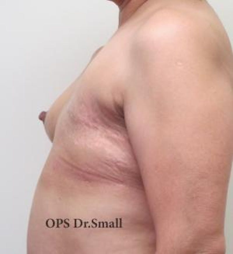 Reconstruction Before & After Gallery - Patient 209545 - Image 3
