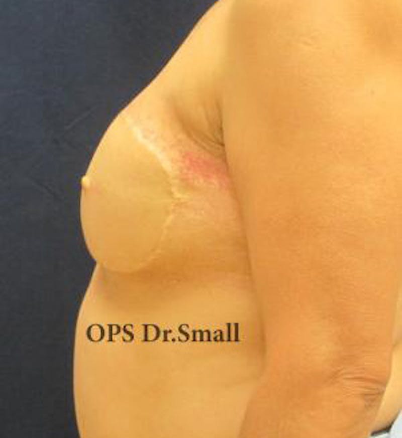 Reconstruction Before & After Gallery - Patient 209545 - Image 4