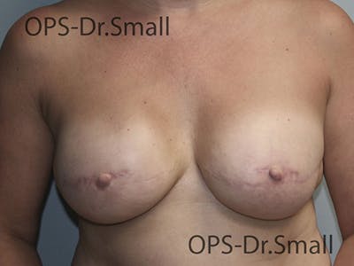 Reconstruction Before & After Gallery - Patient 689532 - Image 2