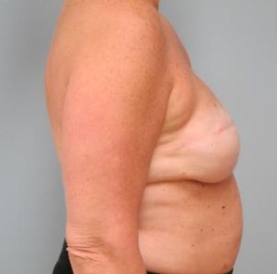 Reconstruction Before & After Gallery - Patient 308396 - Image 1