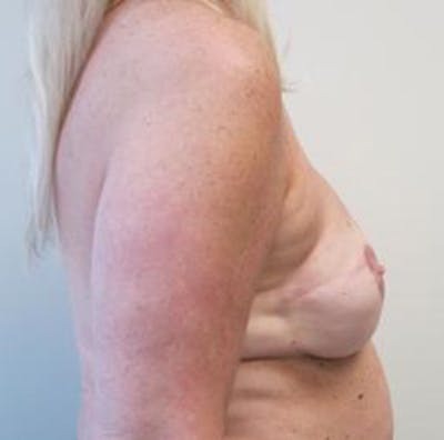 Reconstruction Before & After Gallery - Patient 308396 - Image 2