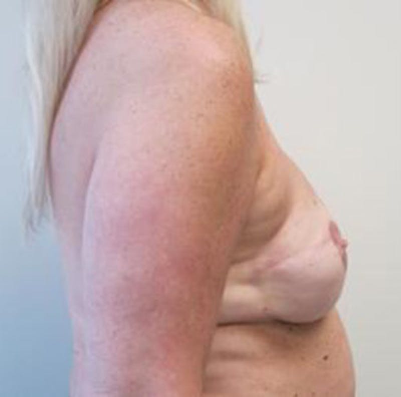 Reconstruction Before & After Gallery - Patient 308396 - Image 2