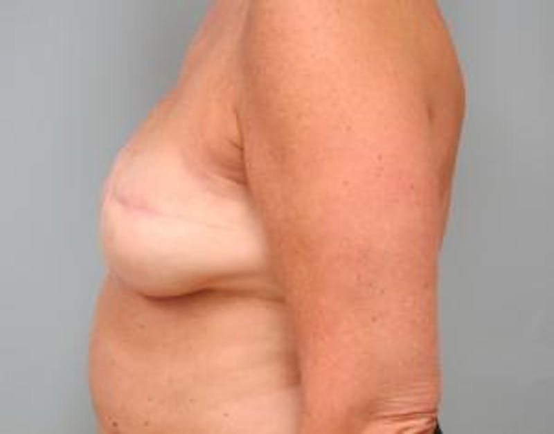 Reconstruction Before & After Gallery - Patient 308396 - Image 3