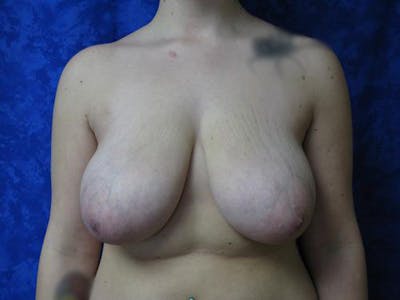 Reduction Before & After Gallery - Patient 803507 - Image 1