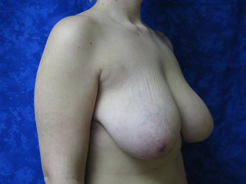 Reduction Before & After Gallery - Patient 803507 - Image 3