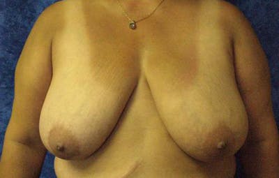 Reduction Before & After Gallery - Patient 389283 - Image 1
