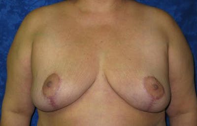 Reduction Before & After Gallery - Patient 389283 - Image 2