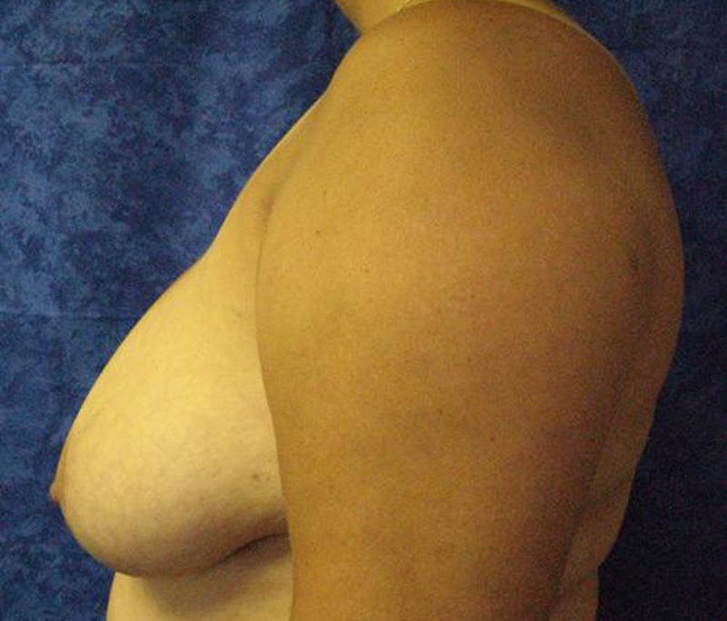 Reduction Before & After Gallery - Patient 389283 - Image 5