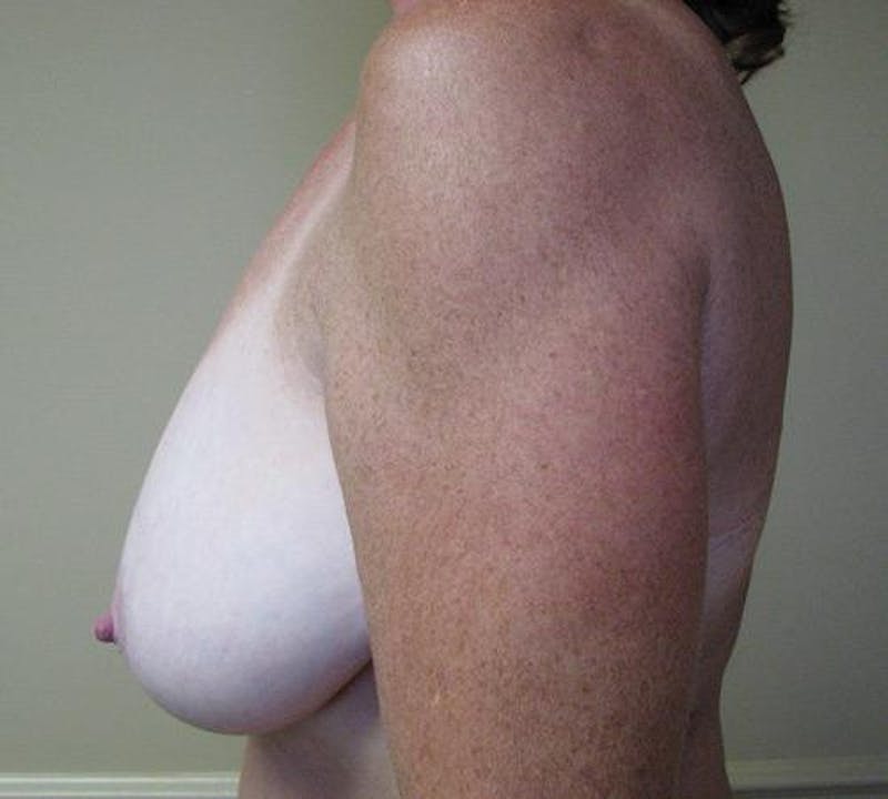 Reduction Before & After Gallery - Patient 229943 - Image 3