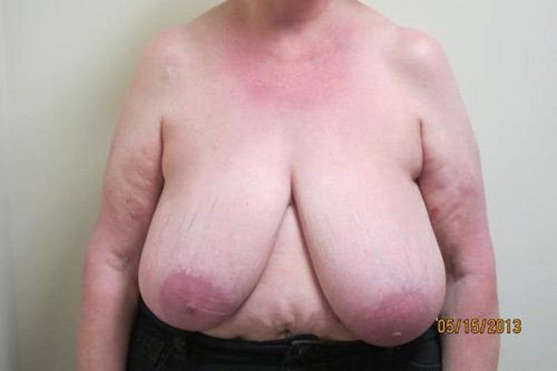Reduction Before & After Gallery - Patient 216881 - Image 1