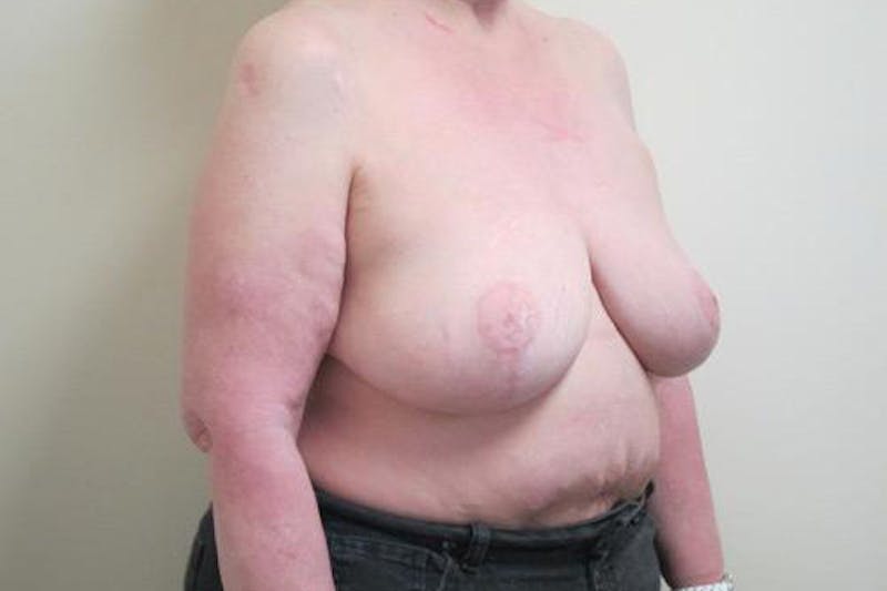 Reduction Before & After Gallery - Patient 216881 - Image 4