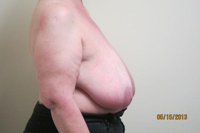 Reduction Before & After Gallery - Patient 216881 - Image 5