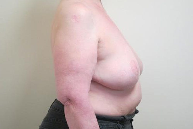 Reduction Before & After Gallery - Patient 216881 - Image 6