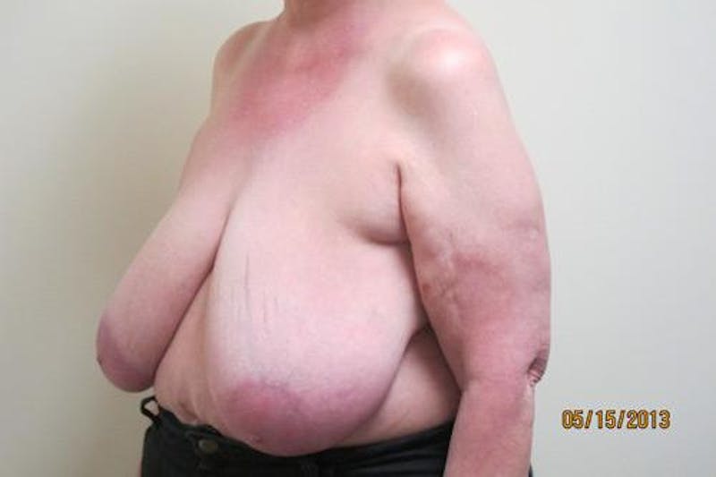 Reduction Before & After Gallery - Patient 216881 - Image 7