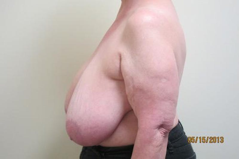 Reduction Before & After Gallery - Patient 216881 - Image 9
