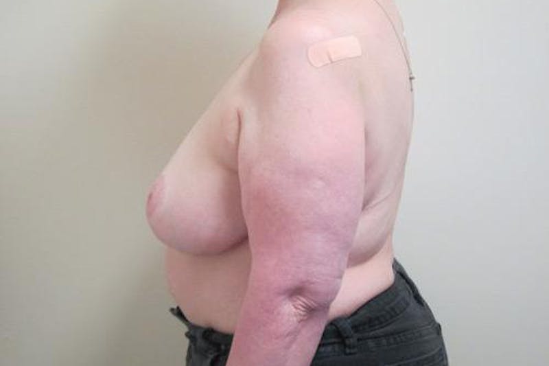 Reduction Before & After Gallery - Patient 216881 - Image 10