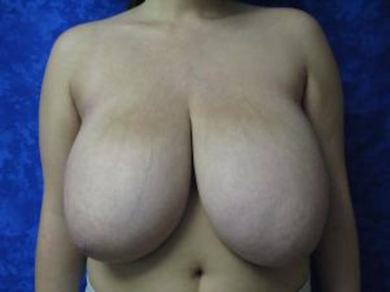 Reduction Before & After Gallery - Patient 211171 - Image 1