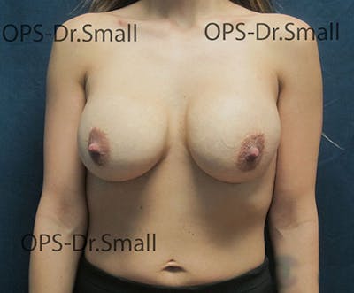 Revision Surgery Before & After Gallery - Patient 324311 - Image 1