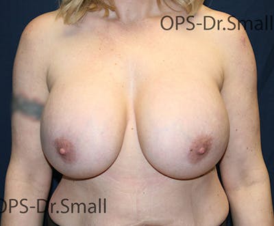 Revision Surgery Before & After Gallery - Patient 439116 - Image 1
