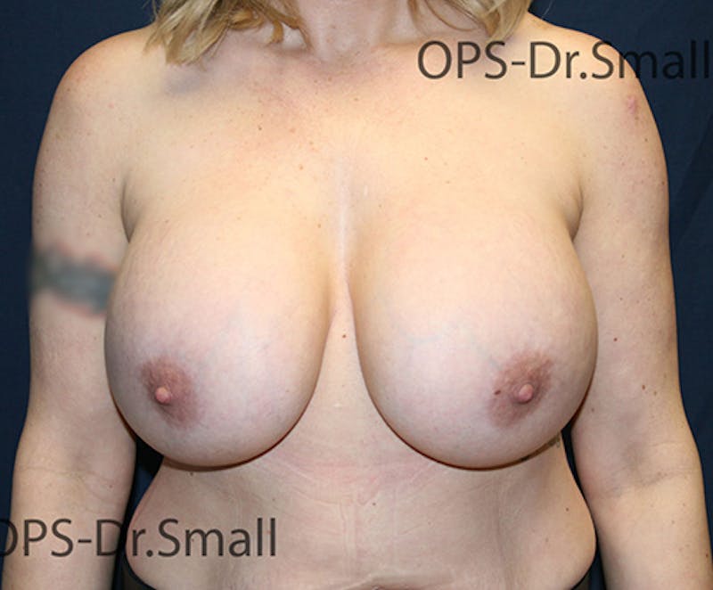 Revision Surgery Before & After Gallery - Patient 439116 - Image 1