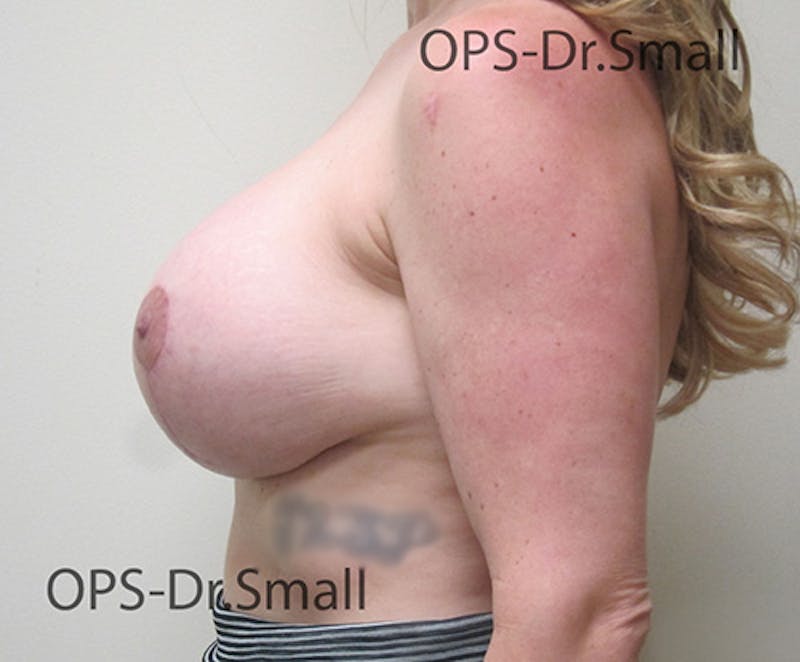 Revision Surgery Before & After Gallery - Patient 439116 - Image 10